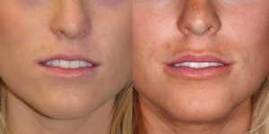 Before-And-After-Lip-Enhancement-Lip-Filler-Cosmetic-Surgery-Newport-Beach-1