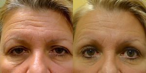 Jeffrey-Joseph-MD-Eyelid-Surgery-Patient-endoscopic-brow-lift-bilateral-upper-eyelid-blepharoplasty-bilateral-internal-ptosis-repair