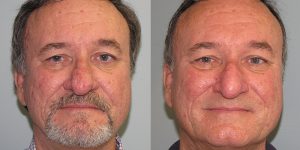 Before-After-Rhinophyma-Appearance-Center-Newport-Beach-Orange-County-Simon-Madorsky-MD3.2