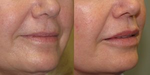 Before-And-After-Lip-Enhancement-Lip-Filler-Cosmetic-Surgery-Newport-Beach-1