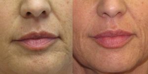 Before-And-After-Lip-Enhancement-Lip-Filler-Cosmetic-Surgery-Newport-Beach-1