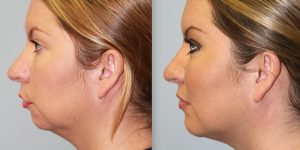 Chin-Implant-Steven-Daines-MD-Appearance-Center-Newport-Beach-Orange-County-Plastic-Surgery.1