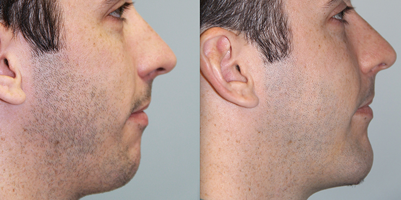 Chin-Implant-Steven-Daines-MD-Appearance-Center-Newport-Beach-Orange-County-Plastic-Surgery.2