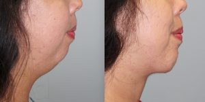 Chin-Implant-Steven-Daines-MD-Appearance-Center-Newport-Beach-Orange-County-Plastic-Surgery.5