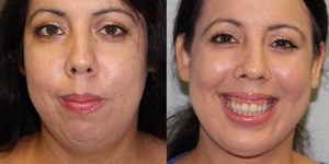 Chin-Implant-Steven-Daines-MD-Appearance-Center-Newport-Beach-Orange-County-Plastic-Surgery.5.4