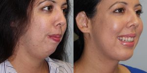 Chin-Implant-Steven-Daines-MD-Appearance-Center-Newport-Beach-Orange-County-Plastic-Surgery.5.5