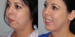 Chin-Implant-Steven-Daines-MD-Appearance-Center-Newport-Beach-Orange-County-Plastic-Surgery.5.56jpg