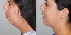 Chin-Implant-Steven-Daines-MD-Appearance-Center-Newport-Beach-Orange-County-Plastic-Surgery.5.8