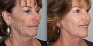 Face-and-Neck-Lift-Steven-Daines-MD-Appearance-Center-Newport-Beach-Orange-County-Plastic-Surgery.16.6