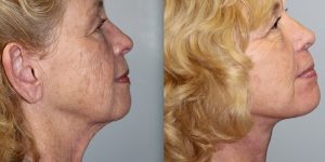 Face-and-Neck-Lift-Steven-Daines-MD-Appearance-Center-Newport-Beach-Orange-County-Plastic-Surgery.2.2