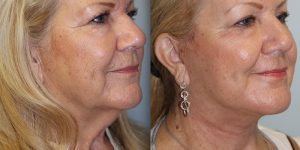 Face-and-Neck-Lift-Steven-Daines-MD-Appearance-Center-Newport-Beach-Orange-County-Plastic-Surgery.5.5