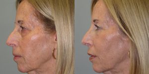 Injectable-Patient-Appearance-Center-Simon-Madorsky-MD-Radiesse-and-Restylane-to-Face-Injectable-Treatments (1)