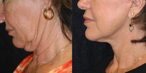 Neck-lift-Appearance-Center-Newport-Beach-Cosmetic-Surgery-Orange-County