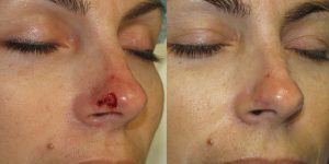 Nose-Reconstruction-After-Skin-Cancer-Excision-Skin-Cancer-And-Reconstructive-Surgery-Center-Newport-Beach-Orange-County