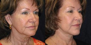 Facelift-Appearance-Center-Newport-Beach-Cosmetic-Surgery-Orange-County2
