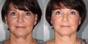 Facelift-Appearance-Center-Newport-Beach-Cosmetic-Surgery-Orange-County