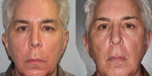 Rhinoplasty-Simon-Madorsky-MD-Appearance-Center-Cosmetic-Surgery1 - Copy