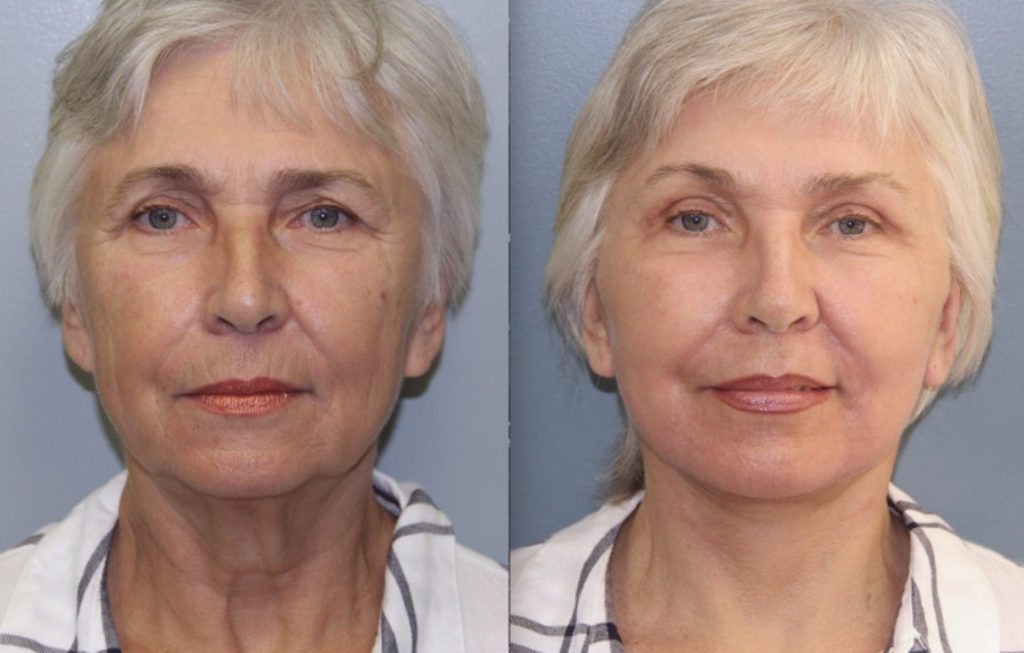 Plastic Surgery, Facial Rejuvenation, Fillers & Injectables