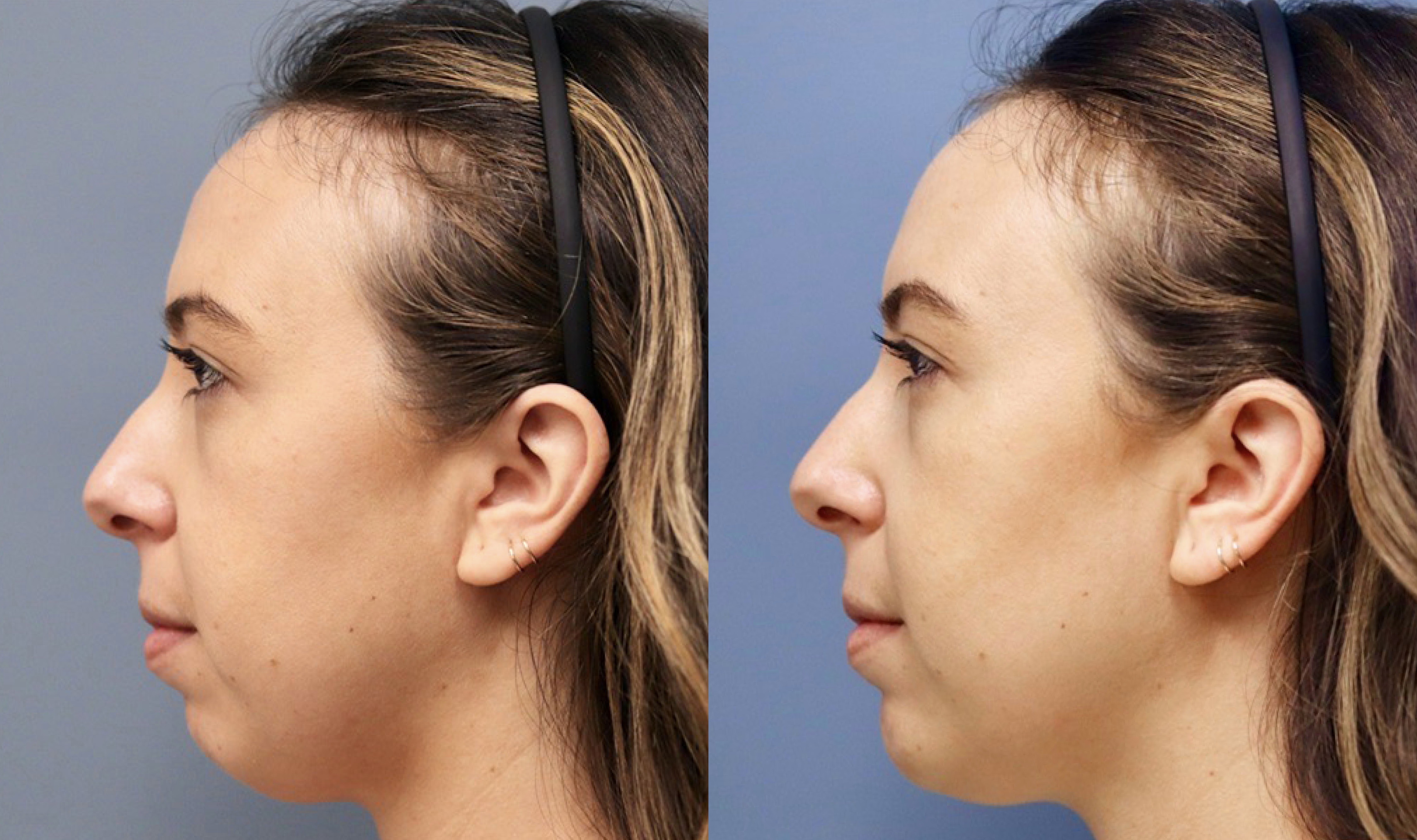 chin fillers before and after