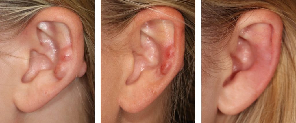 earlobe keloid removal