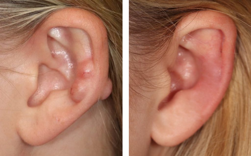 Management of Keloid Scars caused by Ear Piercings Appearance Center