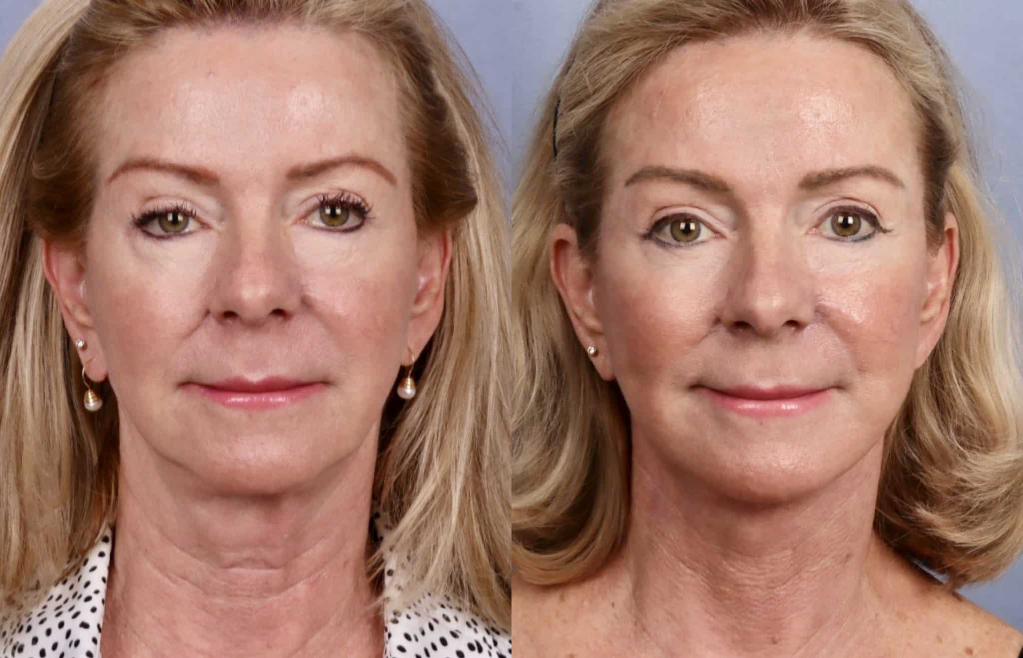 Before & After Images