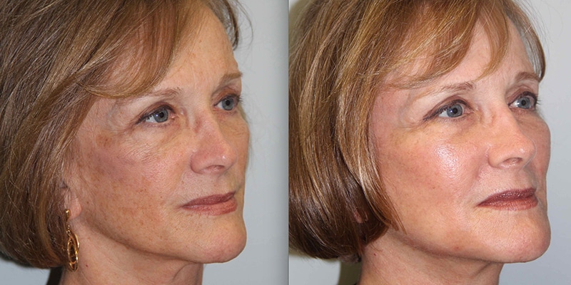 Before & After Image