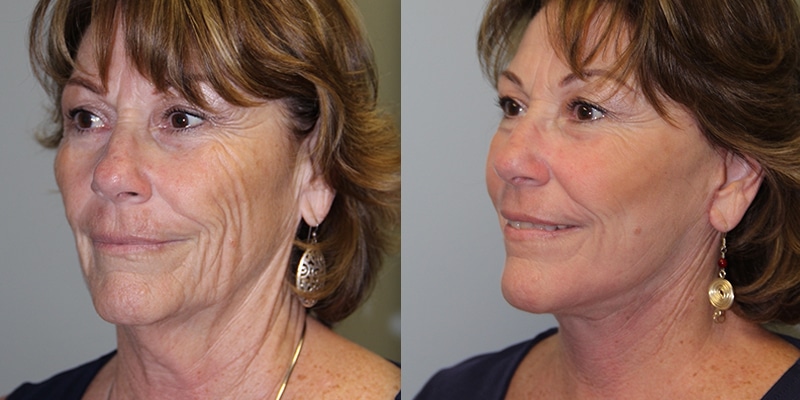 Before & After Image