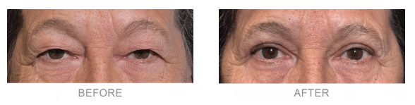1764027280_Dr.-Jane-Kim-Upper-Blepharoplasty
