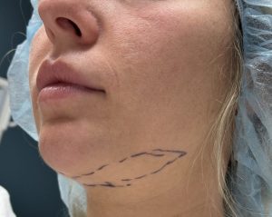 1764027299_jawline-liposuction-submental-liposuction-jaw-contour-1.jpg-1-300x239.jpg