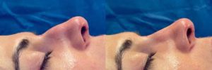 1764027359_Preservation-Rhinoplasty-on-the-table-1-300x100.jpg