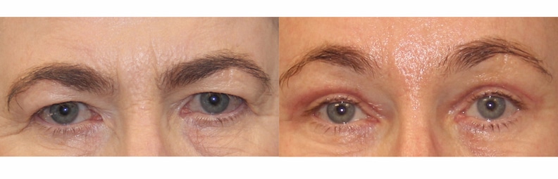 1764027875_DAINES-WEBSITE-EYELID-2-2