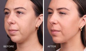 1764028056_Jawline-filler-jawline-enhancement-newport-beach-1.jpg-1