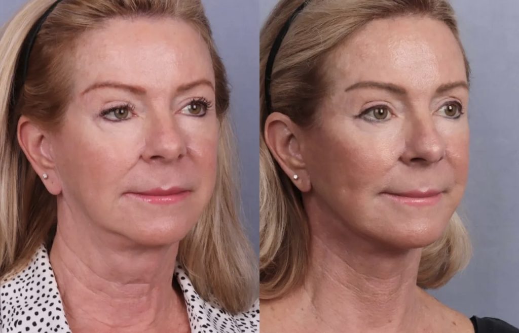 Before & After Images