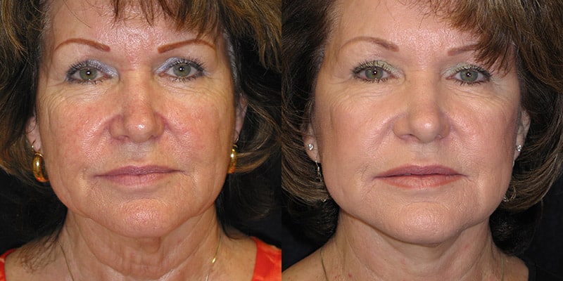 Before & After Image