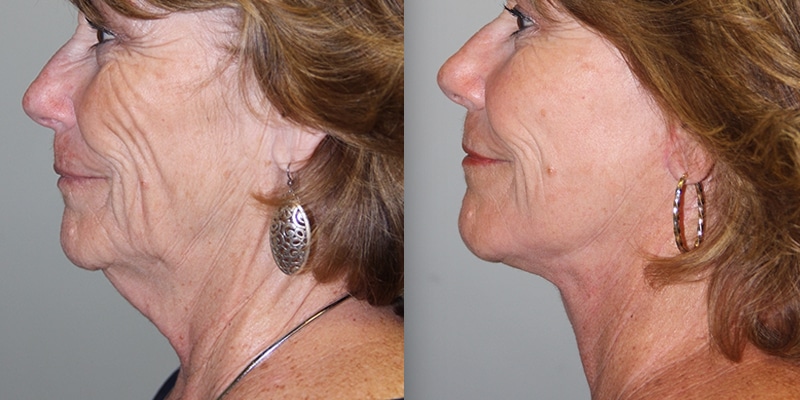 Before & After Images Before & After Images