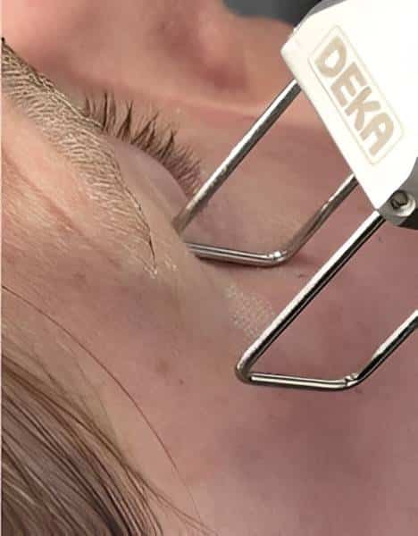 FRACTIONAL CO2 LASER