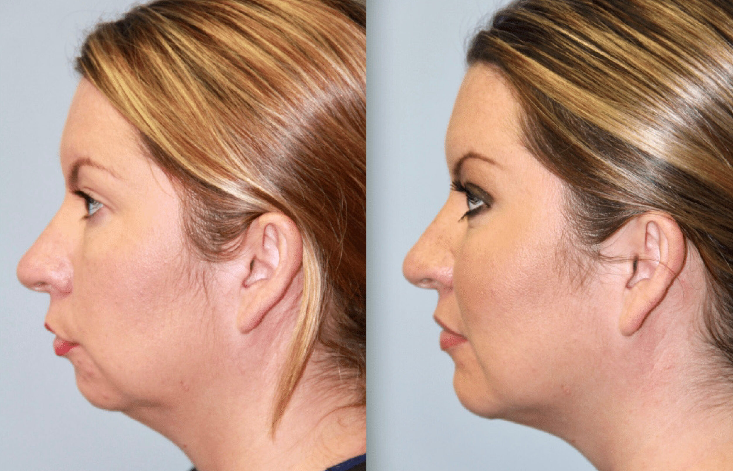 Before and After Image: Chin Surgery, Submentoplasty - left-side