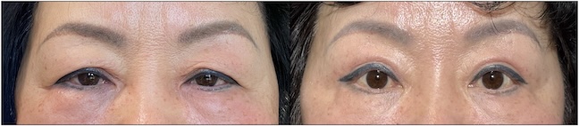 Before and After Image: Upper Blepharoplasty - front