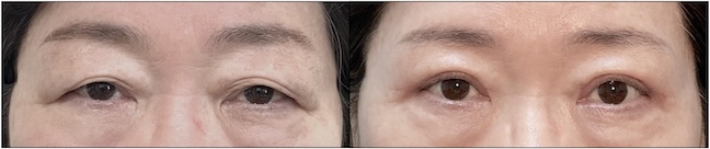 Before and After Image: Upper Blepharoplasty - front