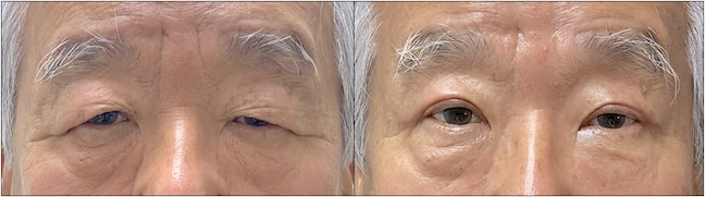 Before and After Image: Upper Blepharoplasty - front