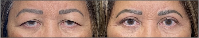 Before and After Image: Upper Blepharoplasty - front