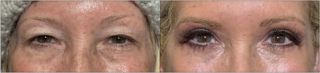 Before and After Image: Upper Blepharoplasty - front