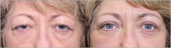 Before and After Image: Upper Blepharoplasty - front