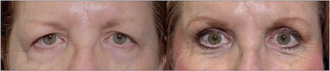 Before and After Image: Upper Blepharoplasty - front