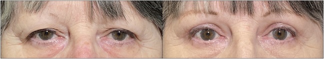Before and After Image: Upper Blepharoplasty - front