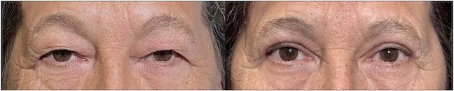 Before and After Image: Upper Blepharoplasty - front