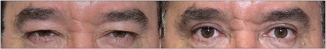Before and After Image: Upper Blepharoplasty - front