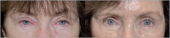 Before and After Image: Upper Blepharoplasty - front