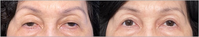 Before and After Image: Upper Blepharoplasty - front